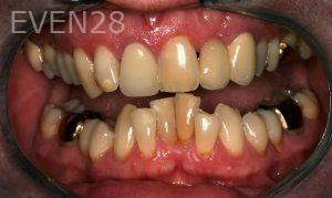 Peter-Suh-Dental-Crowns-before-1