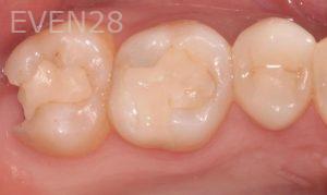 Peter-Suh-Dental-Crowns-before-4