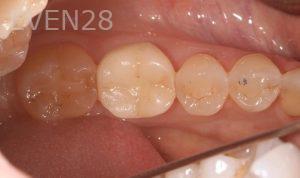 Peter-Suh-Dental-Implants-after-1