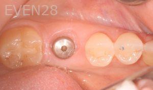 Peter-Suh-Dental-Implants-before-1