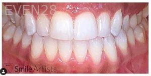 Priyanka-Assudani-Teeth-Whitening-after-1