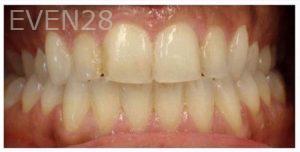 Priyanka-Assudani-Teeth-Whitening-before-1