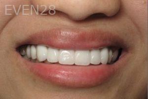 Ramsey-Amin-All-on-Four-Dental-Implants-after-1