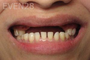 Ramsey-Amin-All-on-Four-Dental-Implants-before-1