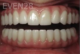 Ramsey-Amin-All-on-Six-Dental-Implants-after-1