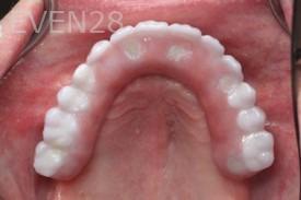 Ramsey-Amin-All-on-Six-Dental-Implants-after-2