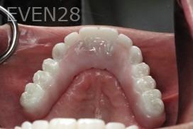 Ramsey-Amin-All-on-Six-Dental-Implants-after-3b