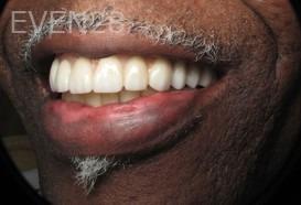 Ramsey-Amin-All-on-Six-Dental-Implants-after-4
