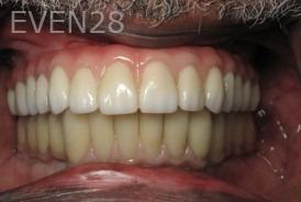 Ramsey-Amin-All-on-Six-Dental-Implants-after-4b