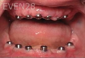 Ramsey-Amin-All-on-Six-Dental-Implants-before-1