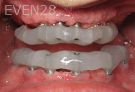 Ramsey-Amin-All-on-Six-Dental-Implants-before-1b