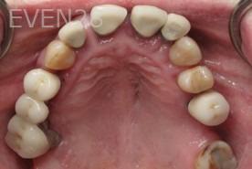 Ramsey-Amin-All-on-Six-Dental-Implants-before-2