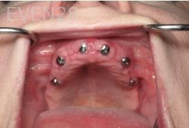 Ramsey-Amin-All-on-Six-Dental-Implants-before-2b