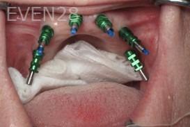 Ramsey-Amin-All-on-Six-Dental-Implants-before-2c