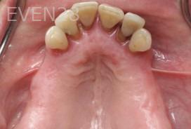 Ramsey-Amin-All-on-Six-Dental-Implants-before-3b