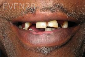 Ramsey-Amin-All-on-Six-Dental-Implants-before-4