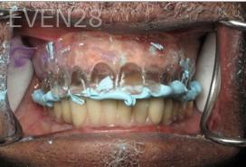 Ramsey-Amin-All-on-Six-Dental-Implants-before-4b