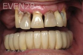 Ramsey-Amin-All-on-Six-Dental-Implants-before3
