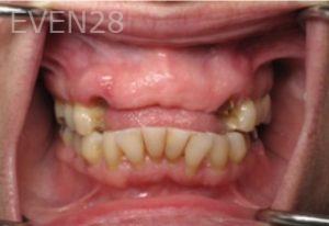 Ramsey-Amin-Dental-Implant-Bridge-before-1