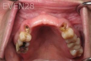 Ramsey-Amin-Dental-Implant-Bridge-before-1b