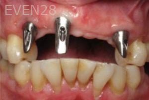 Ramsey-Amin-Dental-Implant-Bridge-before-1c
