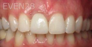 Ramsey-Amin-Dental-Implants-after-1c