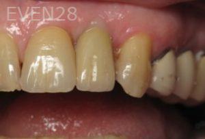 Ramsey-Amin-Dental-Implants-after-2