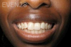 Ramsey-Amin-Dental-Implants-after-3