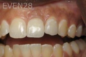 Ramsey-Amin-Dental-Implants-after-3b