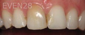 Ramsey-Amin-Dental-Implants-before-1