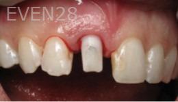 Ramsey-Amin-Dental-Implants-before-1b