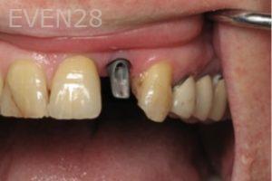Ramsey-Amin-Dental-Implants-before-2