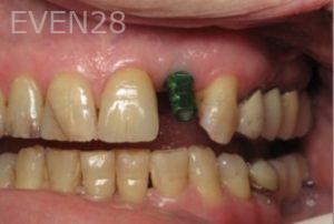 Ramsey-Amin-Dental-Implants-before-2b