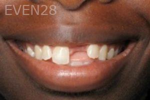 Ramsey-Amin-Dental-Implants-before-3