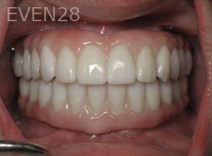 Ramsey-Amin-Full-Mouth-Dental-Implants-after-1b