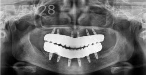 Ramsey-Amin-Full-Mouth-Dental-Implants-after-1c