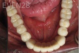 Ramsey-Amin-Full-Mouth-Dental-Implants-after-2