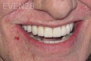 Ramsey-Amin-Full-Mouth-Dental-Implants-after-3