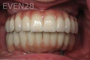 Ramsey-Amin-Full-Mouth-Dental-Implants-after-3b