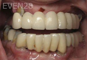 Ramsey-Amin-Full-Mouth-Dental-Implants-before-1b