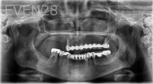 Ramsey-Amin-Full-Mouth-Dental-Implants-before-1c