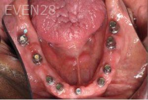 Ramsey-Amin-Full-Mouth-Dental-Implants-before-2