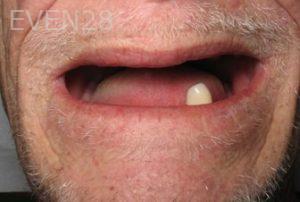 Ramsey-Amin-Full-Mouth-Dental-Implants-before-3