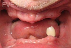 Ramsey-Amin-Full-Mouth-Dental-Implants-before-3b