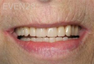 Ramsey-Amin-Implant-Supported-Over-Dentures-after-1