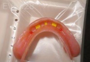 Ramsey-Amin-Implant-Supported-Over-Dentures-after-1b