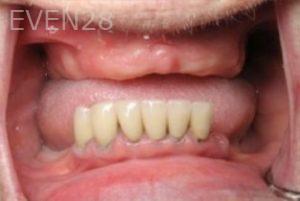 Ramsey-Amin-Implant-Supported-Over-Dentures-before-1