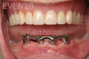 Ramsey-Amin-Implant-Supported-Over-Dentures-before-1b