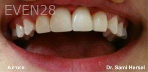 Sami-Hersel-Dental-Bonding-after-6