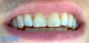 Sami-Hersel-Dental-Bonding-before-2